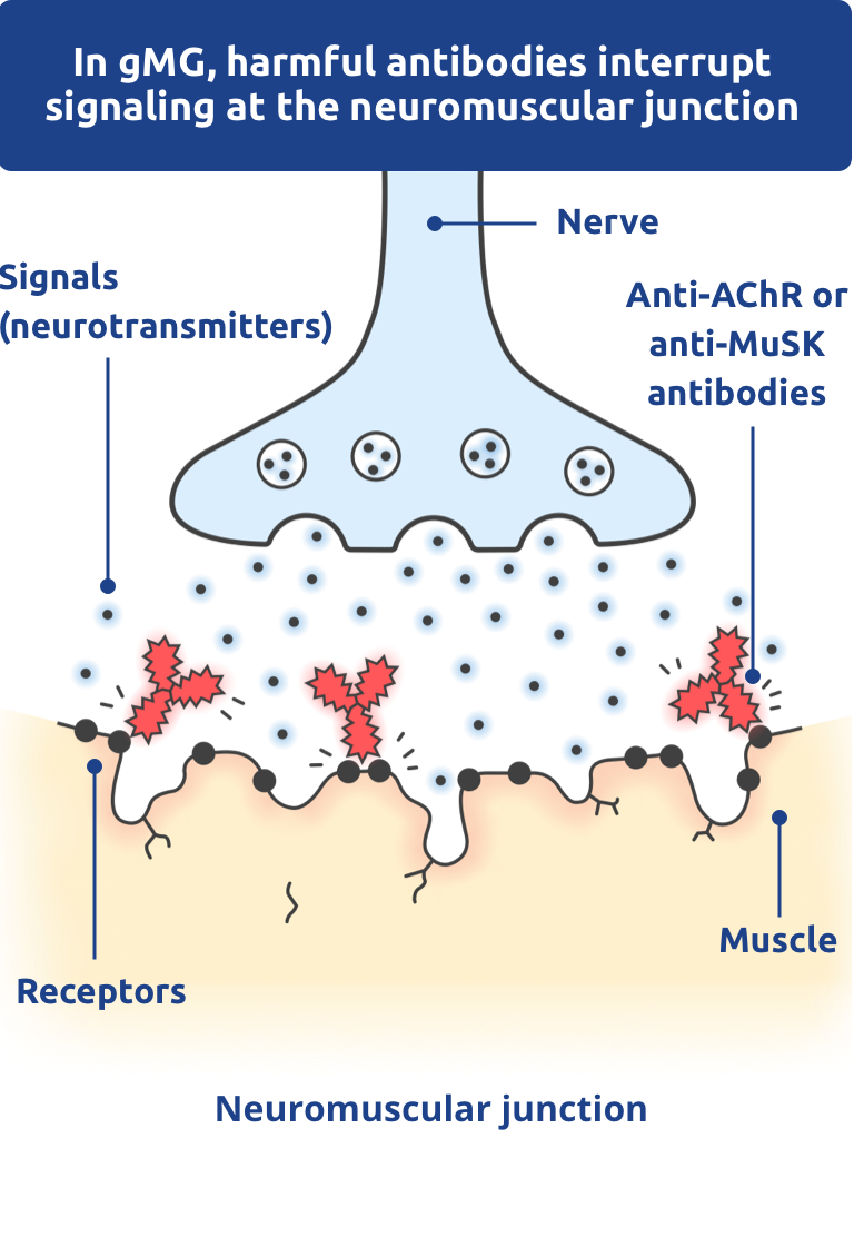 In gMG, harmful antibodies interrupt signaling at the neuromuscular junction.