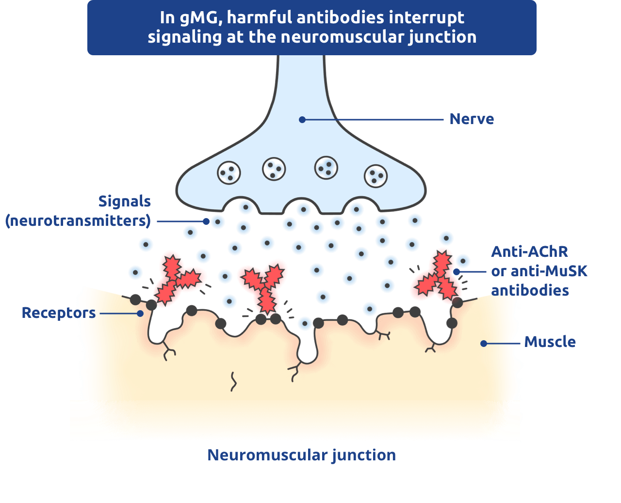 In gMG, harmful antibodies interrupt signaling at the neuromuscular junction.