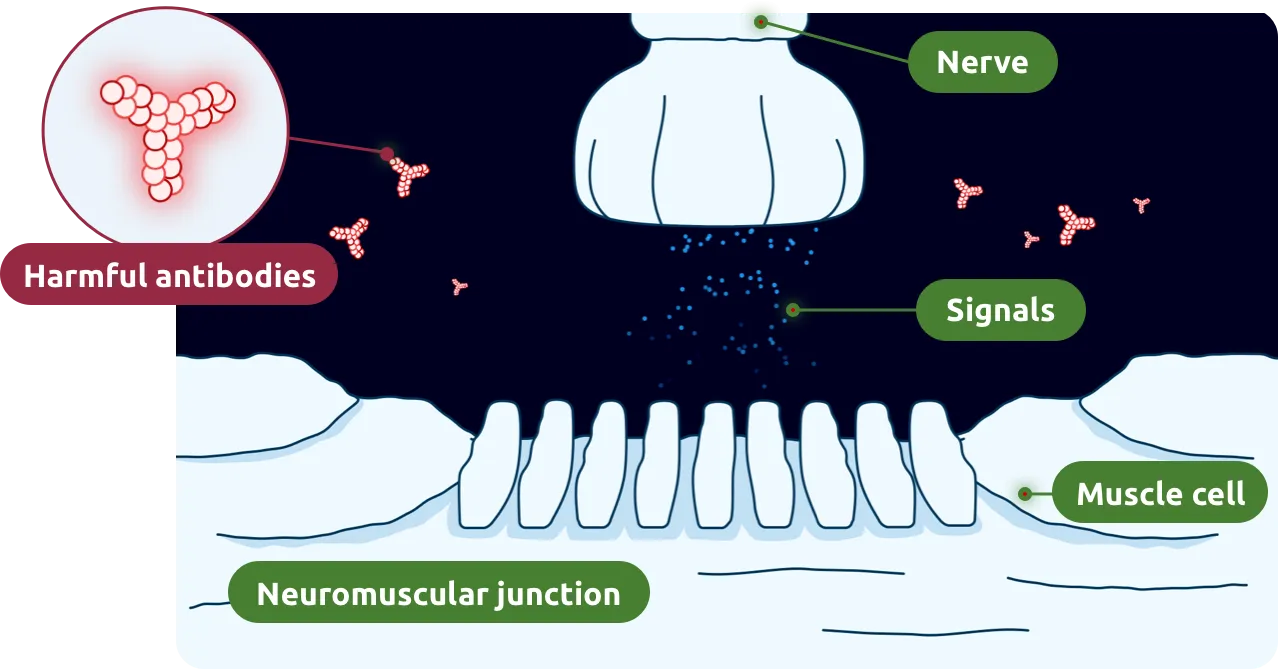 In gMG, harmful antibodies interrupt signaling at the neuromuscular junction.